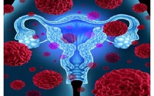 دانستنی هایی درباره فیبروم رحمی