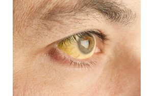 زرد شدن پوست نشانه زردی (یرقان) است؟