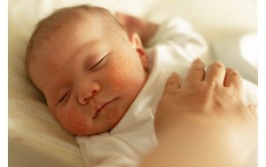 شایع‌ترین بثورات ویروسی در نوزادان