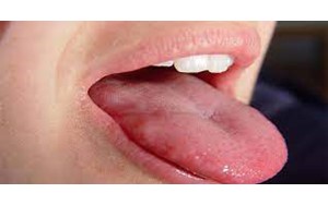 علائم کم‌خونی روی زبان