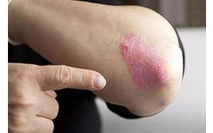 با بیماری پسوریازیس و علائم آن آشنا شوید