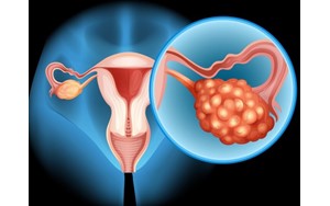 فیبروم رحمی چیست؟